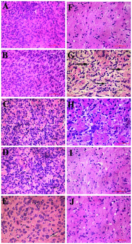 Malacotic periventricular brain tissues caused by hypox | Open-i