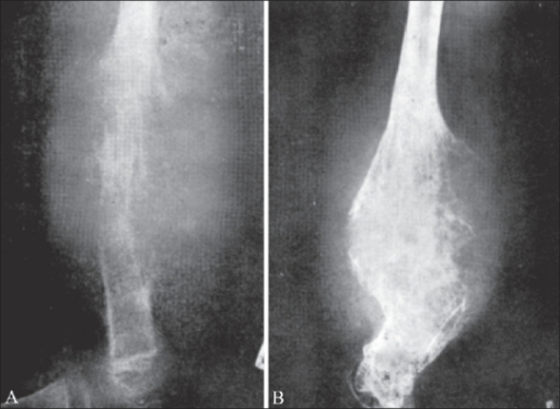 Ewing's sarcoma of the femur. Pre-irradiation radiograp | Open-i