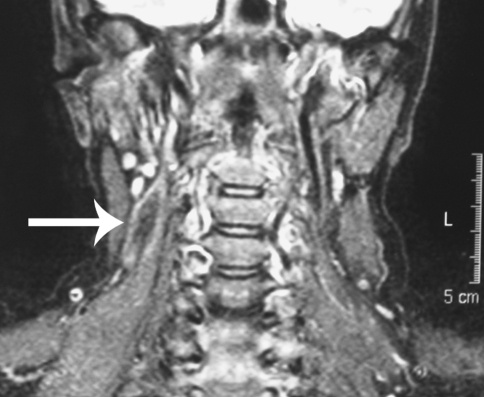 T2-weighted MRI scan of neck (coronal view). The tumour | Open-i