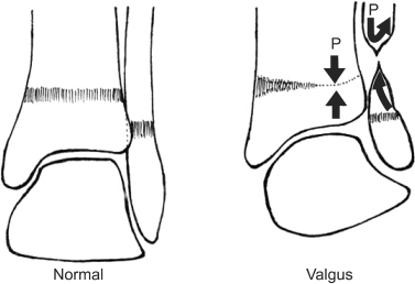 genu valgus right knee icd 10