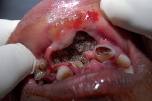 Intraoral photograph showing maggots in upper labial vestibule.