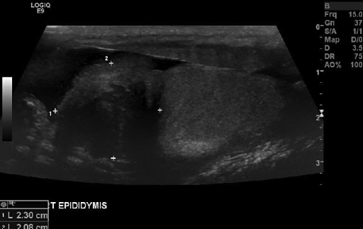 Scrotal ultrasound showing a solid hypoechoic ill-defin | Open-i