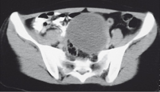 CT scan showing a large left ovarian cyst | Open-i