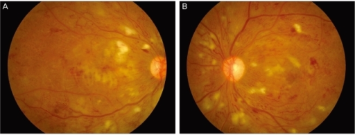 Retinal hemorrhages, cotton wool spots, macular edema, | Open-i