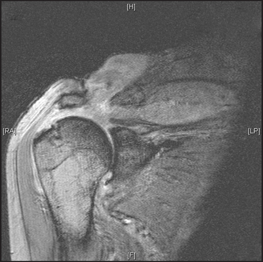 MRI Scan Showing A Large Glenohumeral Joint Effusion Wi Open I   PMC3391787 IJSS 6 64 G002 