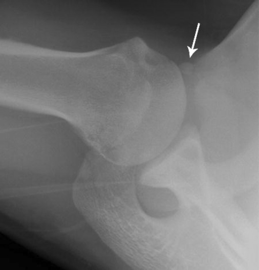 West Point radiographic projection of the right shoulde | Open-i