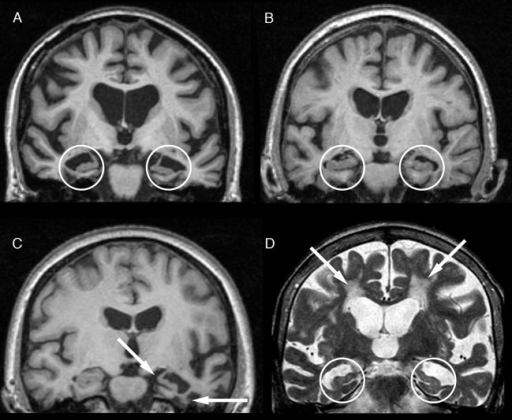 alzhiemiers disease hca 240 Hca 240 week 2 assignment infectious disease essay sexually transmitted disease that has affected many people and altered many lives and a disease that i hope one. alzhiemiers disease hca 240 Hca 240 week 2 assignment infectious disease essay sexually transmitted disease that has affected many people and altered many lives and a disease that i hope one.