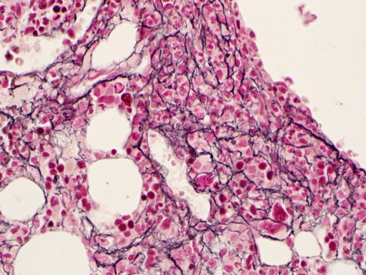 Reticulin Fibrosis In The Bone Marrow Reticulin Stain Bone Marrow Biopsy