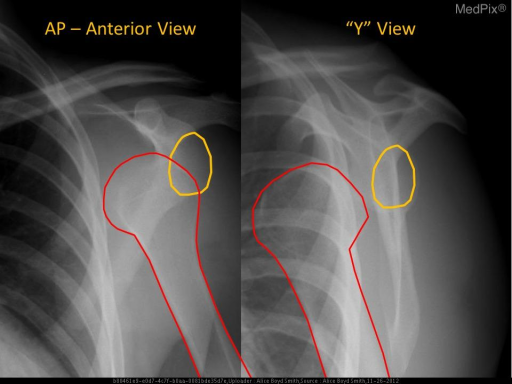 Frontal and scapular Y views of the shoulder (now shown | Open-i