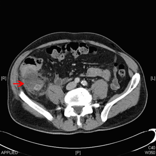 Computed tomography scan showing appendix mucocele. | Open-i