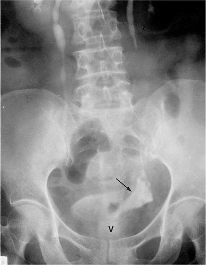 Vesicovaginal Fistula Symptoms