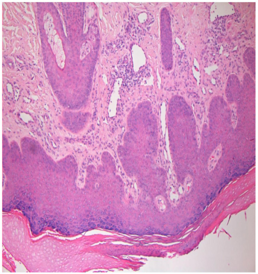 Histology of skin rash: nodular prurigo. | Open-i