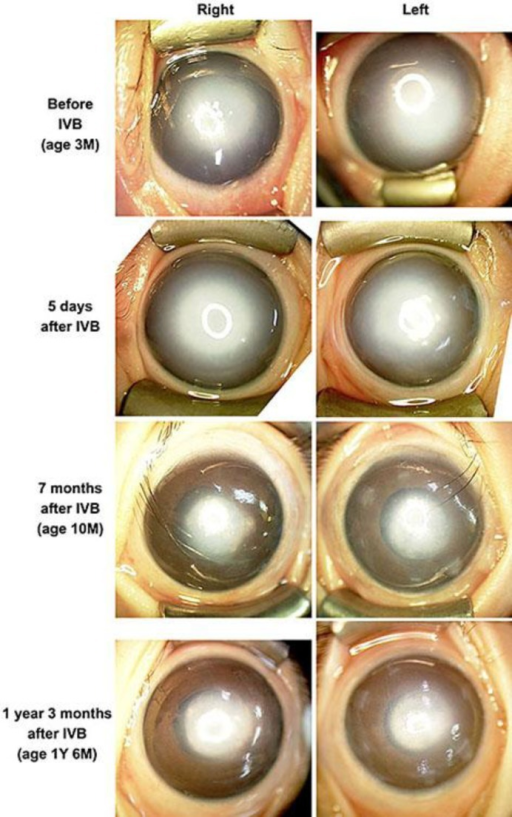 Photographs of the anterior segment of eyes with Peters | Open-i