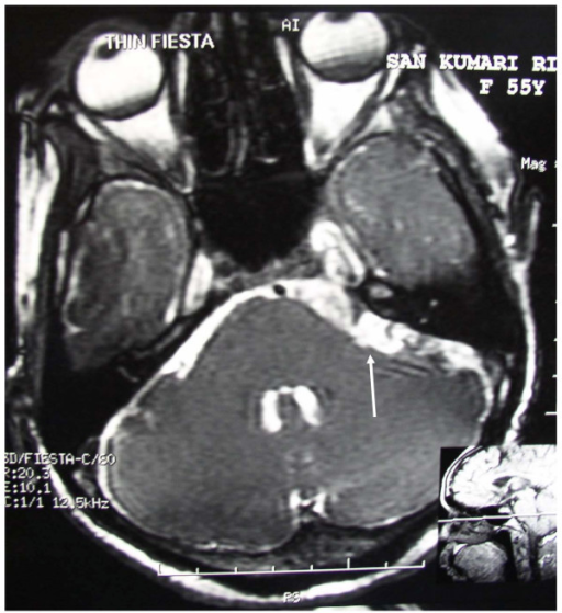 Gasserian Ganglion Anatomy 3994