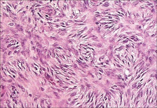 Spindle shaped cells are seen arranged in a storiform pattern [Hematoxylin and eosin, ×40]