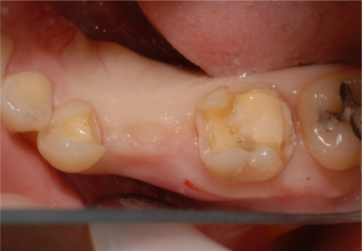 Occlusal view showing inlay-onlay cavity preparation | Open-i