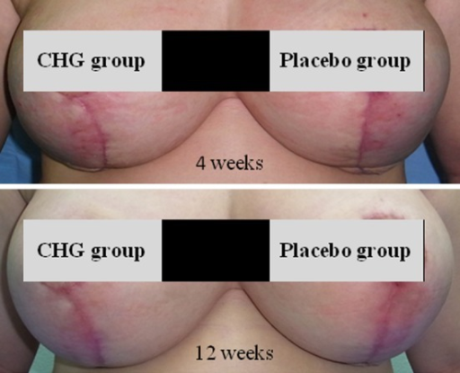 40 Year Woman After Breast Reduction