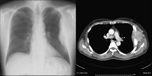 Tumor On Chest X Ray