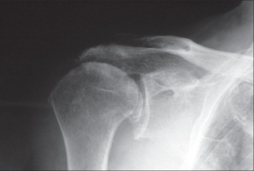 Preoperative X-ray showing osteoarthritis of the shoulder