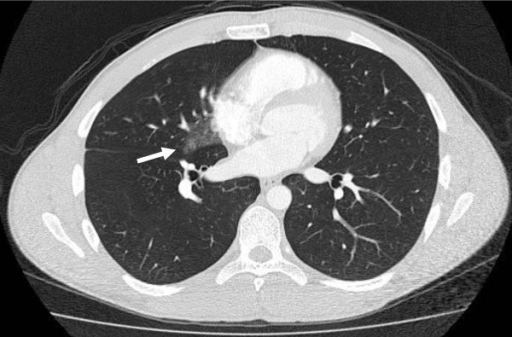 Pulmonary contusion in the right lung. CT of the chest 