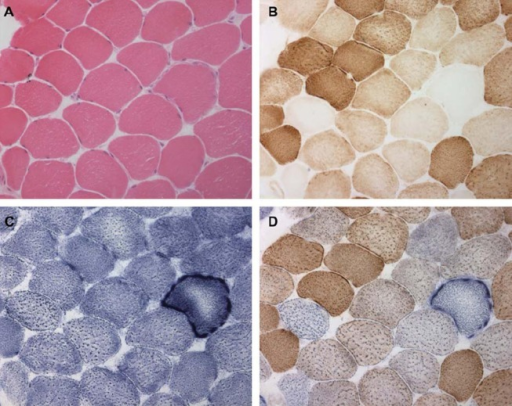 Abnormalities on skeletal muscle biopsy in mitochondrial myopathy. Serial sections through vastus lateralis in a patient with mitochondrial myopathy showing: (A) haematoxylin and eosin, (B) cytochrome c oxidase histochemistry (COX) (note the COX deficient fibres), (C) succinate dehydrogenase histochemistry (SDH) (note the sub-sarcolemmal accumulation of mitochondria analogous to a ragged red fibre), and (D) sequential COX-SDH histochemistry showing a mosaic COX defect as seen in patients with mtDNA disorders.