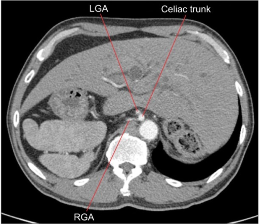 CT scan demonstrating the right gastric artery arising | Open-i