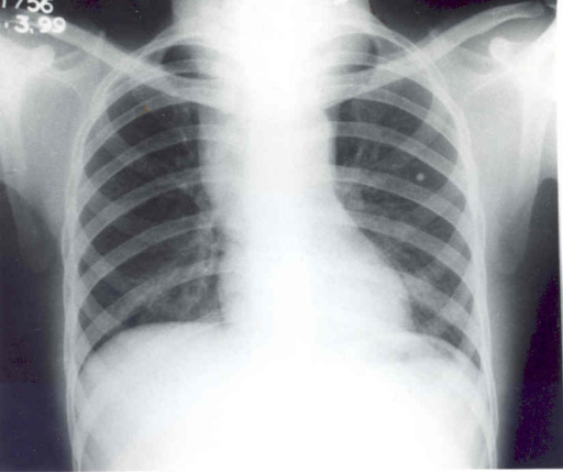 Chest X-ray (p-a View) Showing Widening Of The Mediasti 