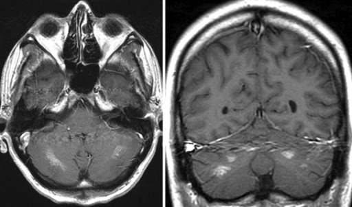 MRI scan (axial and coronar) with symmetric contrast ag | Open-i