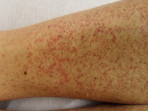 skin-lesion-of-the-patient-on-lower-extremities-genera-open-i