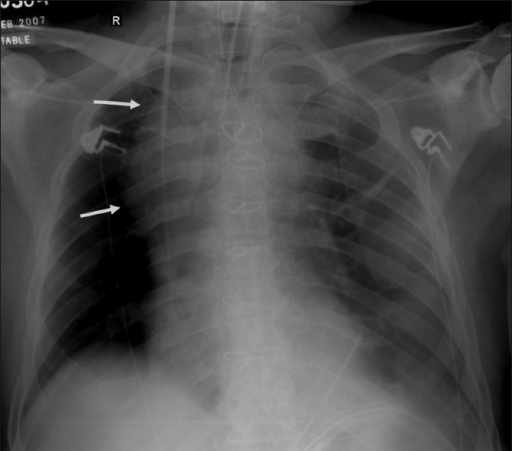 Frontal chest radiograph following placement of a centr | Open-i