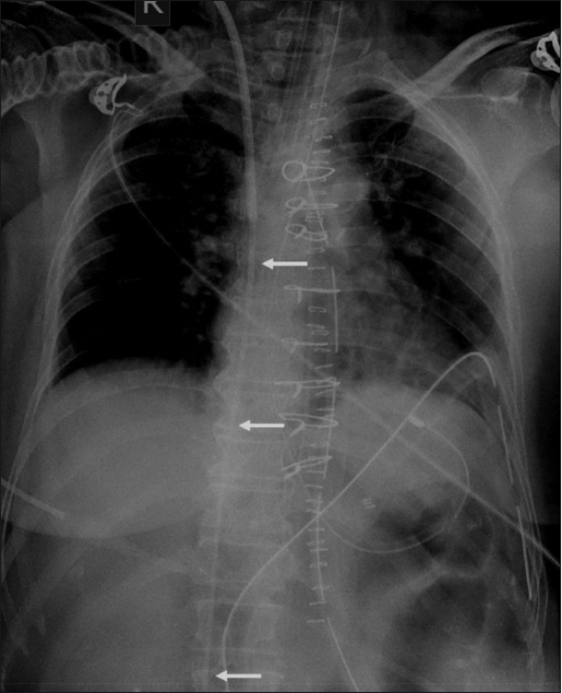 Swan Ganz Catheter Radiology