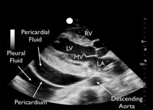 Differentiation of a pericardial effusion from a pleura | Open-i