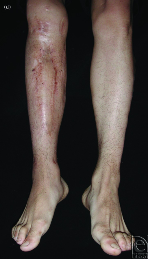 Case 3: Osteomyelitis of the lower leg. (a) Preoperativ | Open-i