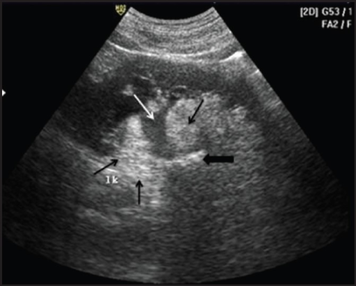 Longitudinal ultrasound scan of left kidney showing mod | Open-i