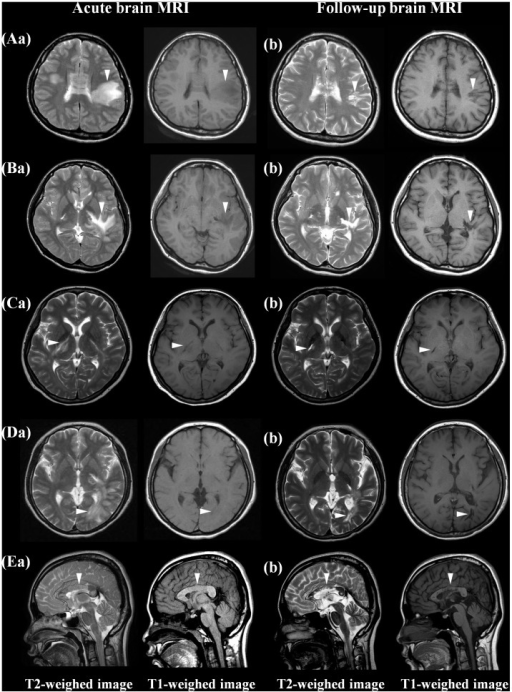 showing-diffuse-white-matter-lesions-on-mri-of-brain-t2-axial