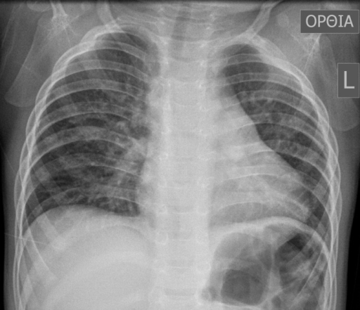 Typical preoperative chest X‐ray of a 16‐month‐old boy with tetralogy of Fallot.