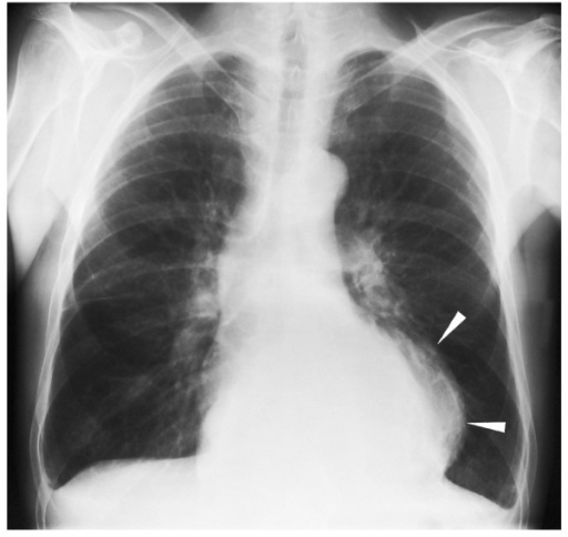 Chest X-ray on admission. Initial examination showed an | Open-i