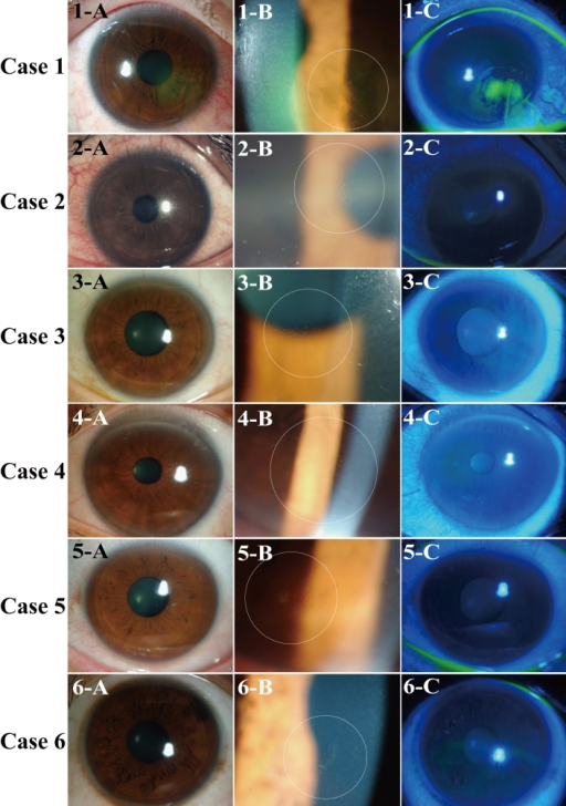 Slit lamp biomicroscopic findings of the six cases of t | Open-i