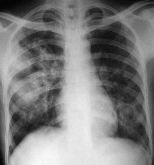 Chest X Ray Shows Bilateral Pulmonary Infiltrates Righ Open I My XXX Hot Girl