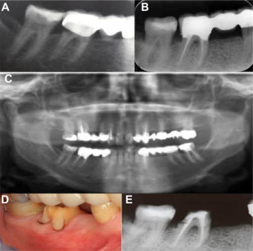 A) Preoperative radiograph of tooth #46. (B) Postopera