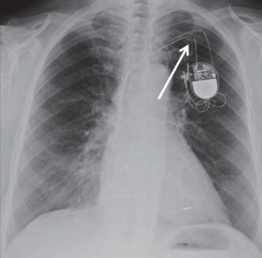 Complete lead fracture. PA chest X-ray of a malfunction | Open-i