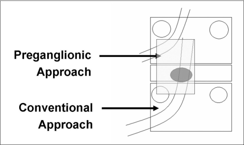 Retrodiscal transforaminal epidural steroid injection