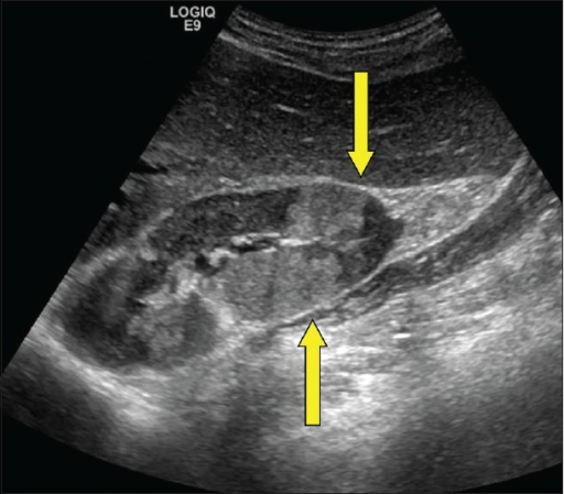 Hyperechoic Liver Lesion Ultrasound