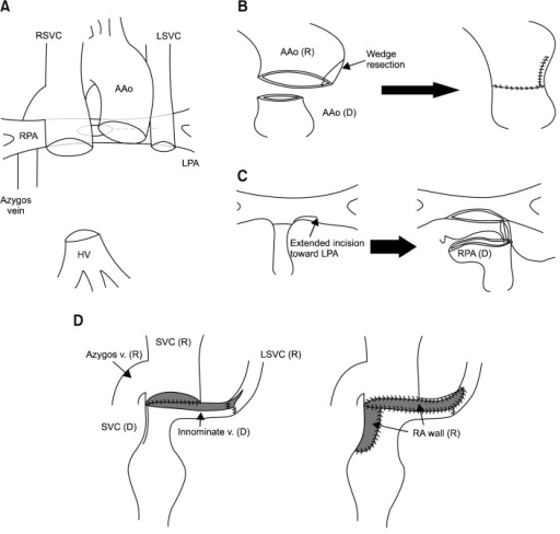 (A) Schematic drawing after the recipient’s heart exc | Open-i