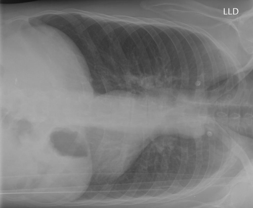 chest-radiograph-ap-and-left-lateral-decubitus-xxxx-xxx-open-i