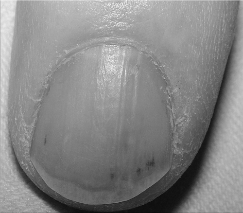 Multiple subungual splinter hemorrhages secondary to in | Open-i