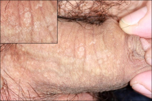 Scaly Skin On Penis 14