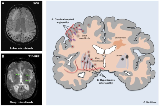 The distribution of sporadic small vessel disease in th | Open-i