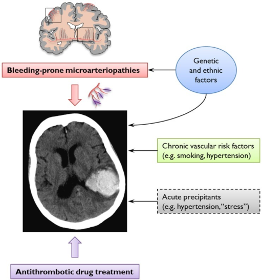 Cerebral amyloid angiopathy as related to Bleeding - Pictures