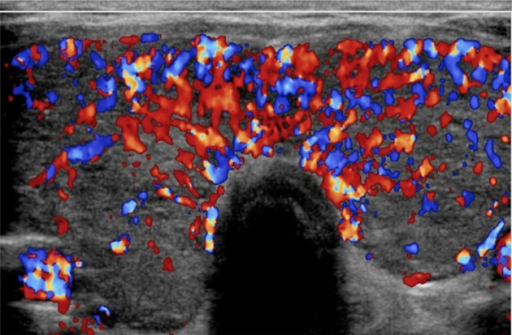 colordoppler-ultrasound-imaging-of-the-thyroid-in-the-p-open-i